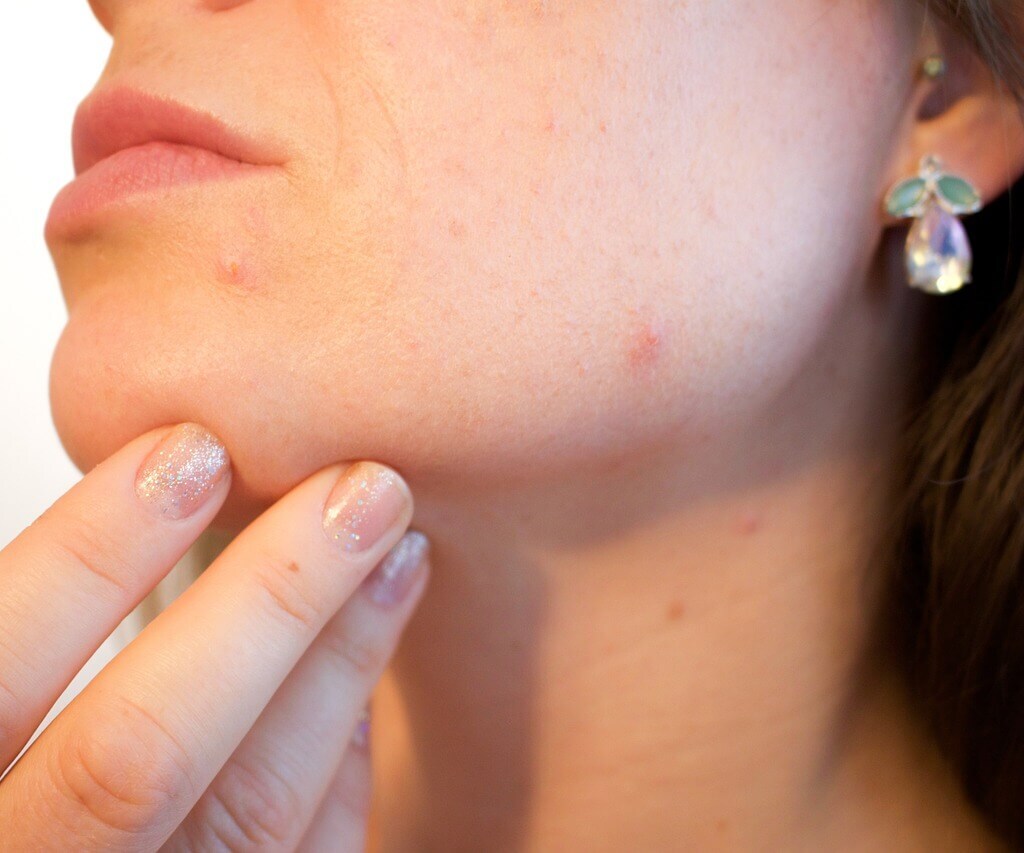 Visage marqué par de l'acné